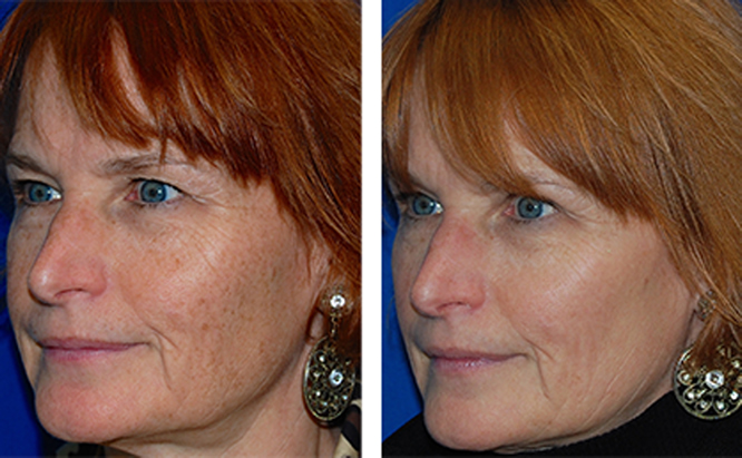 Facial Rejuvenation before and after photo