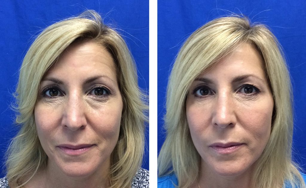 Before and after Botox results