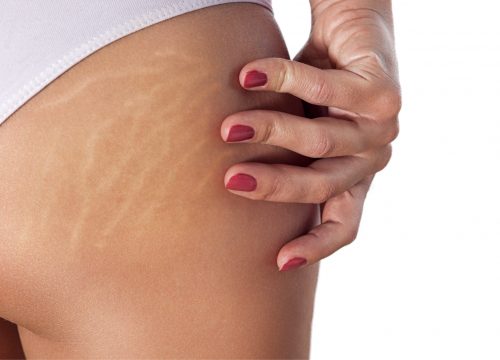 Stretch marks on a woman's backside