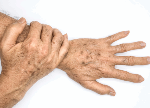 Age Spots / Hyperpigmentation