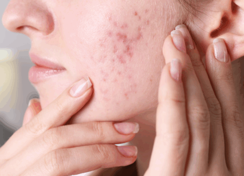 Acne / Acne Scarring