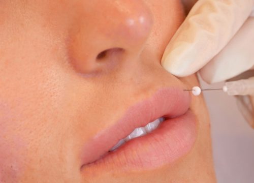 ThreadLift procedure