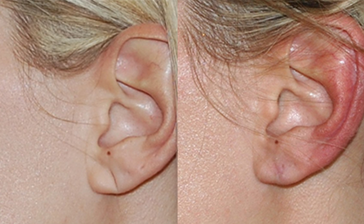 Earlobe Repair  Virginia, Washington D.C. and Maryland