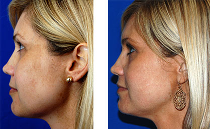 Before and after scar treatments