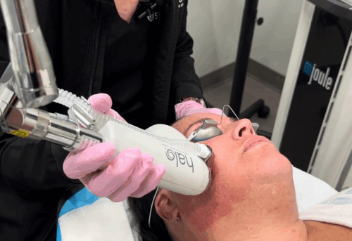 Halo Laser in Richmond, VA 